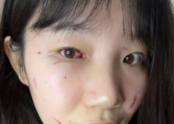 强度这么大？北京女篮中锋鼻骨被打骨折 眼部结膜出血触目惊心