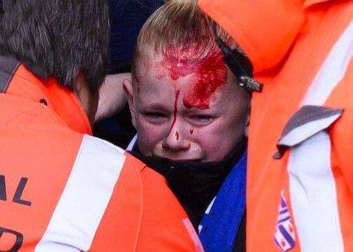 海伦芬VS费耶诺德赛中发生骚乱 一名儿童被打火机砸中头部鲜血直流